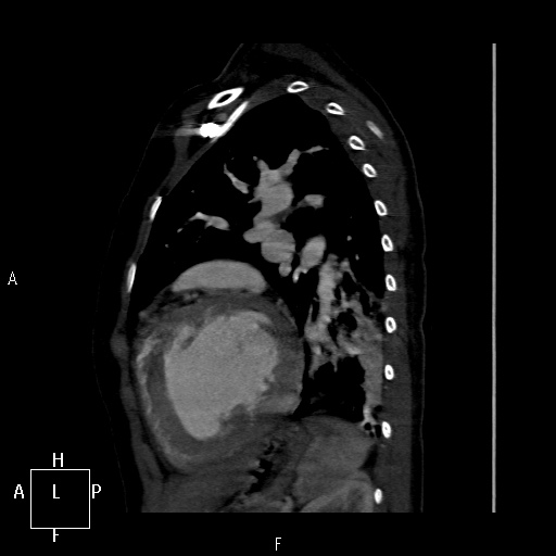 File:Aortopulmonary septal defect (Radiopaedia 41990-45013 Sagittal C+ CTPA 8).jpg