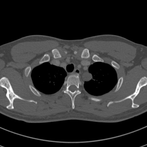 File:Apical lung mass mimic - neurogenic tumor (Radiopaedia 59918-67521 Axial bone window 13).jpg