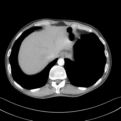 Apical pleural calcification (Radiopaedia 46141-50499 Axial C+ delayed 60).png