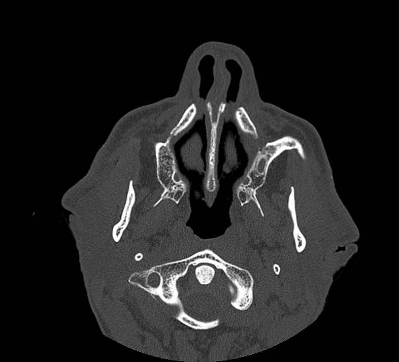 Aplastic maxillary sinuses (Radiopaedia 60030-67561 Axial non-contrast 17).jpg