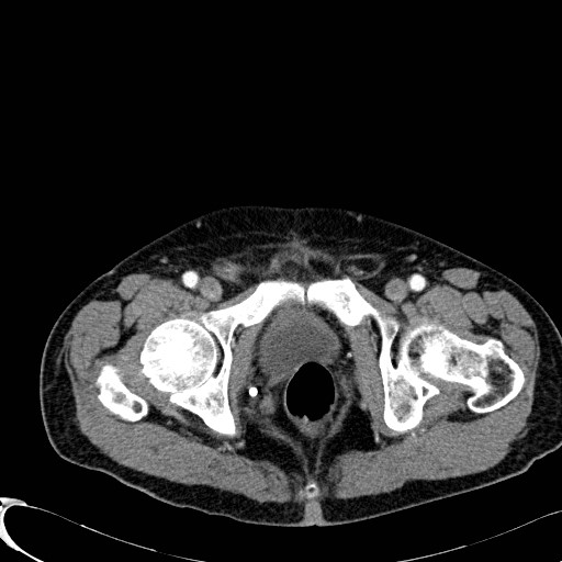 Appendiceal adenocarcinoma complicated by retroperitoneal abscess (Radiopaedia 58007-65039 B 139).jpg