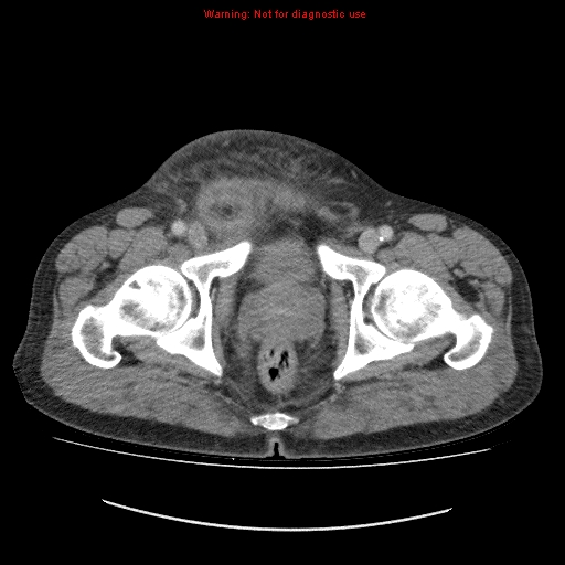 File:Appendicitis mass in inguinal hernia (Radiopaedia 26858-27029 A 28).jpg