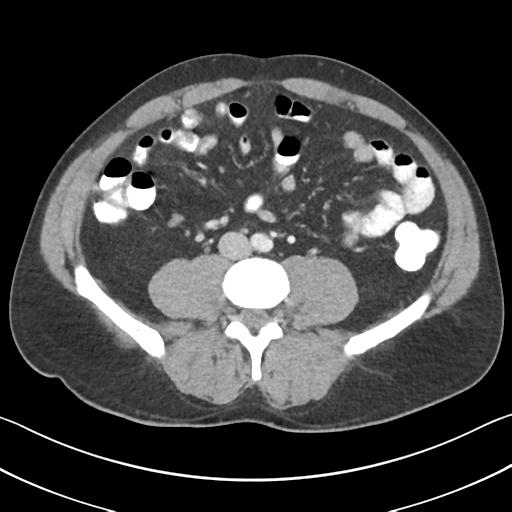 File:Appendicitis with cecal bar sign (Radiopaedia 31878-32830 B 48).jpg