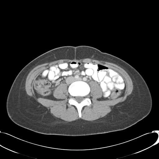 File:Appendicitis with minimal stranding but appendicolith (Radiopaedia 29035-29397 A 50).jpg