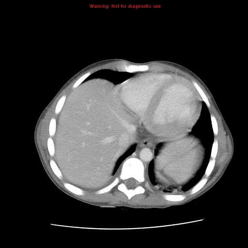 File:Appendicitis with phlegmon (Radiopaedia 9358-10046 A 11).jpg