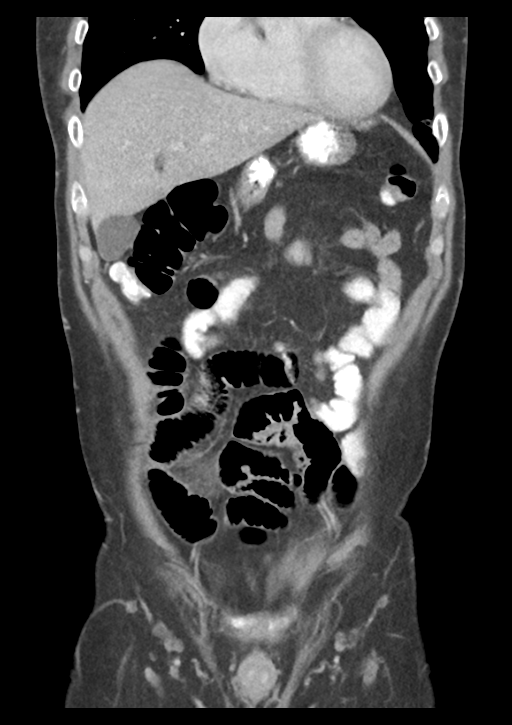 Appendicitis with thickening of the terminal ileum (Radiopaedia 42432-45550 B 16).png