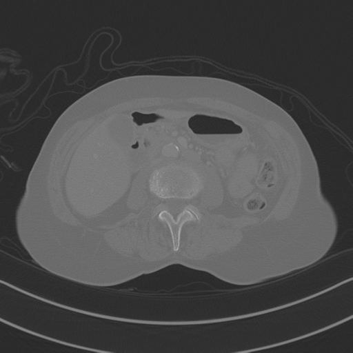 April fools' 2019- calcified peritoneal arachnoidosis (Radiopaedia 67273-76636 Axial bone window 19).png