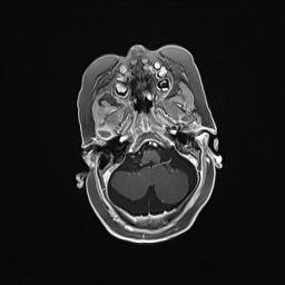 Aqueductal stenosis (Radiopaedia 73974-84802 Axial T1 C+ 45).jpg