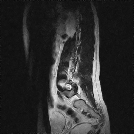 File:Arachnoid cyst - spinal (Radiopaedia 66835-76157 Sagittal T2 11).jpg