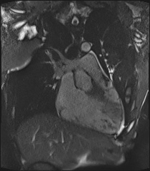 Arrhythmogenic right ventricular cardiomyopathy (Radiopaedia 57972-64966 CINE R2 SSFP 8).jpg