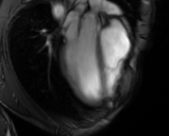 Arrhythmogenic right ventricular cardiomyopathy (Radiopaedia 69564-79464 4ch cine 22).jpg