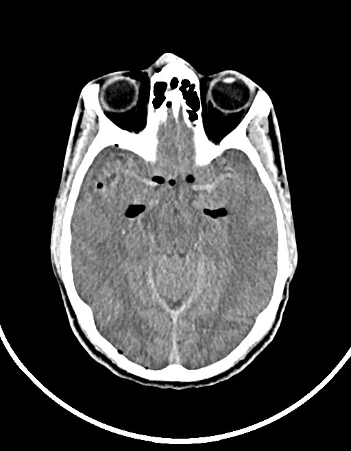 Arrow injury to the brain (Radiopaedia 72101-82607 Axial non-contrast 66).jpg