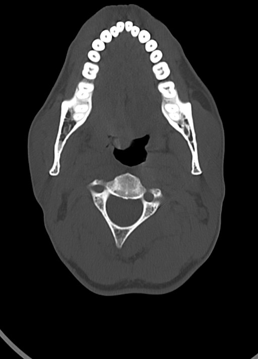 Arrow injury to the head (Radiopaedia 75266-86388 Axial bone window 26).jpg