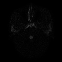 File:Artery of Percheron infarction (Radiopaedia 27975-28230 Axial DWI 4).jpg