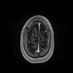 Artery of Percheron infarction (Radiopaedia 27975-28230 Axial T1 C+ fat sat 91).jpg