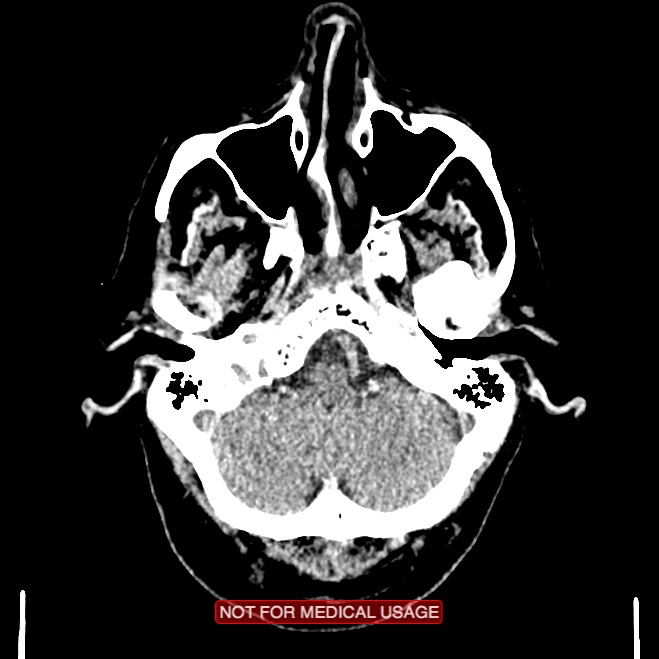 Artery of Percheron infarction (Radiopaedia 28679-28967 Axial non-contrast 20).jpg