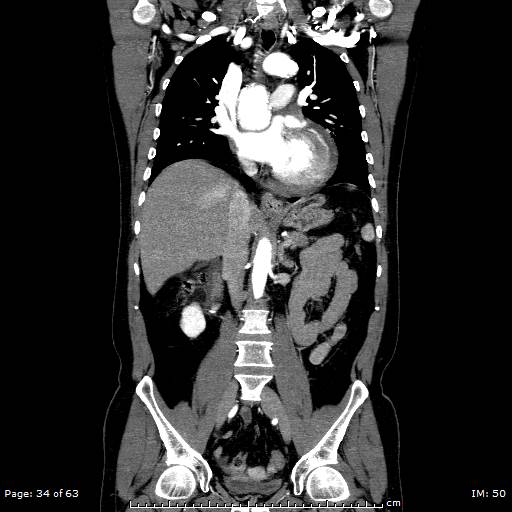 File:Ascending aortic aneurysm (Radiopaedia 50086-55404 B 34).jpg
