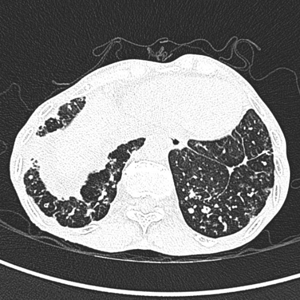 File:Aspergilloma- with Monod sign (Radiopaedia 44737-48532 Axial lung window 257).jpg