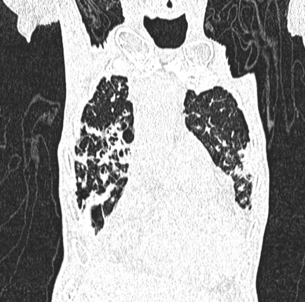 Aspergilloma- with Monod sign (Radiopaedia 44737-48532 Coronal lung window 157).jpg