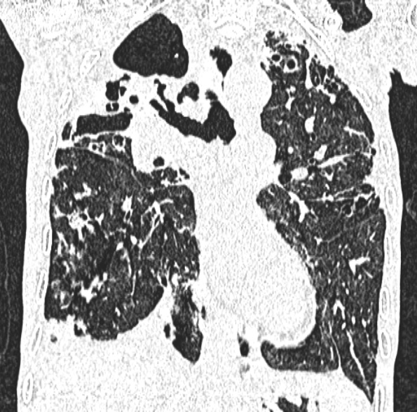 Aspergilloma- with Monod sign (Radiopaedia 44737-48532 Coronal lung window 243).jpg