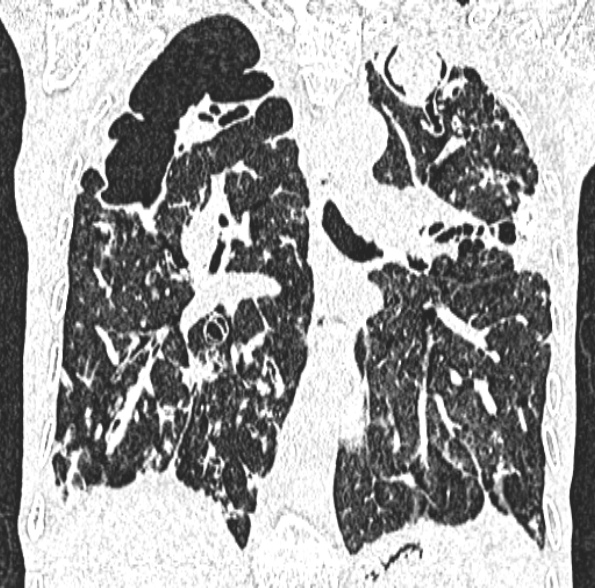 Aspergilloma- with Monod sign (Radiopaedia 44737-48532 Coronal lung window 271).jpg