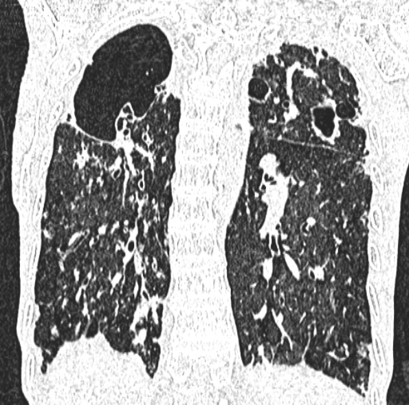 Aspergilloma- with Monod sign (Radiopaedia 44737-48532 Coronal lung window 323).jpg