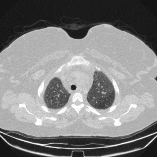 Aspergilloma (Radiopaedia 39611-41932 Axial lung window 20).jpg