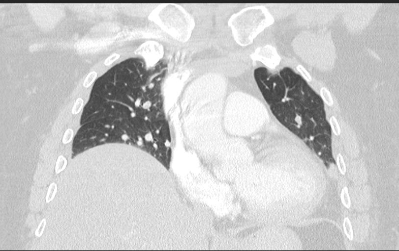 Aspirated tooth (Radiopaedia 28584-28844 Axial lung window 48).jpg