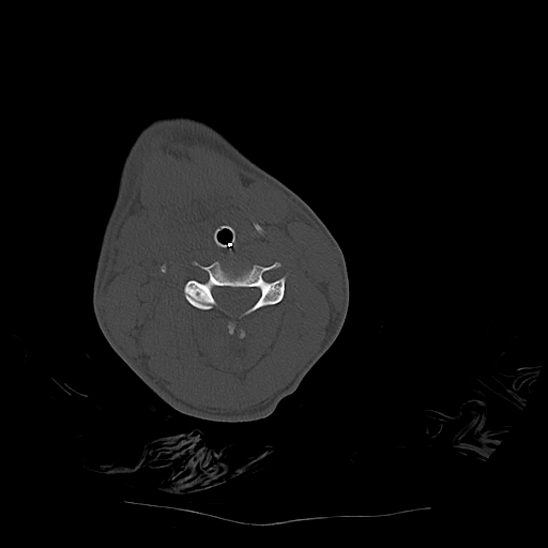 File:Atlanto-occipital dissociation (Traynelis type 1), C2 teardrop fracture, C6-7 facet joint dislocation (Radiopaedia 87655-104061 Axial bone window 47).jpg
