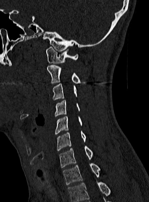 Atlantoaxial subluxation (Radiopaedia 44681-48450 Sagittal bone window 103).jpg