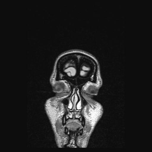 Atretic encephalocoele with inferior vermis hypoplasia (Radiopaedia 30443-31108 Coronal FLAIR 171).jpg