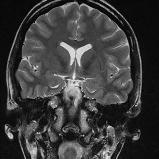 File:Atretic encephalocoele with inferior vermis hypoplasia (Radiopaedia 30443-31108 Coronal T2 11).jpg