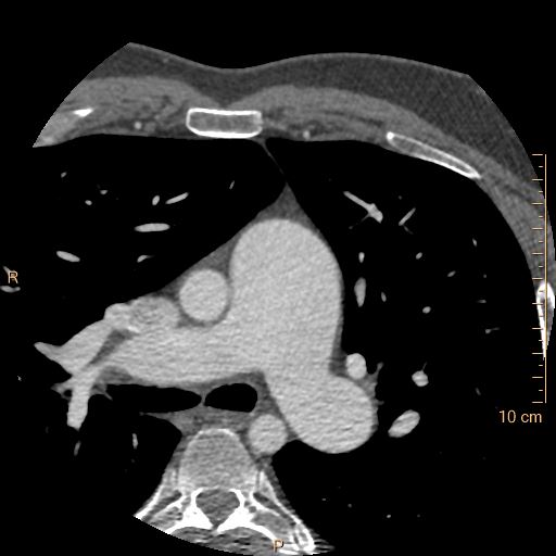 Atrial septal defect (upper sinus venosus type) with partial anomalous pulmonary venous return into superior vena cava (Radiopaedia 73228-83961 A 51).jpg