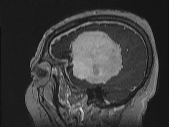 Atypical meningioma (Radiopaedia 62985-71406 Sagittal T1 C+ 80).jpg