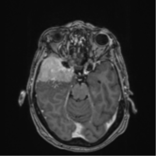 Atypical meningioma (WHO Grade II) (Radiopaedia 54742-60979 Axial T1 C+ 22).png