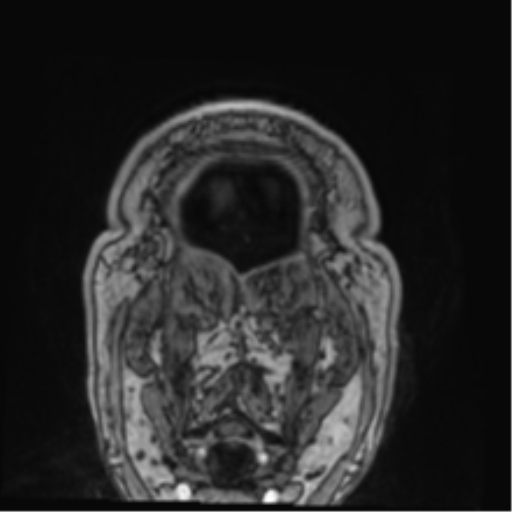 Atypical meningioma (WHO grade II) with brain invasion (Radiopaedia 57767-64729 Coronal T1 C+ 84).png