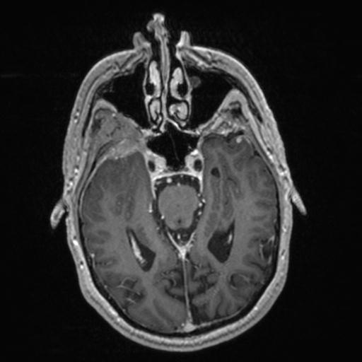 Atypical meningioma (grade II) - en plaque (Radiopaedia 29633-30147 Axial T1 C+ 75).jpg