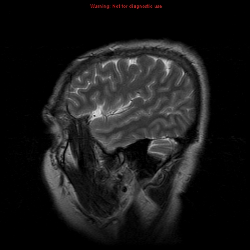 File:Atypical meningioma - grade II (Radiopaedia 13303-13305 Sagittal T2 19).jpg