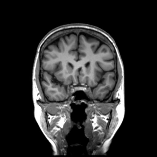 Autoimmune limbic encephalitis (Radiopaedia 30363-31005 Coronal T1 38).jpg