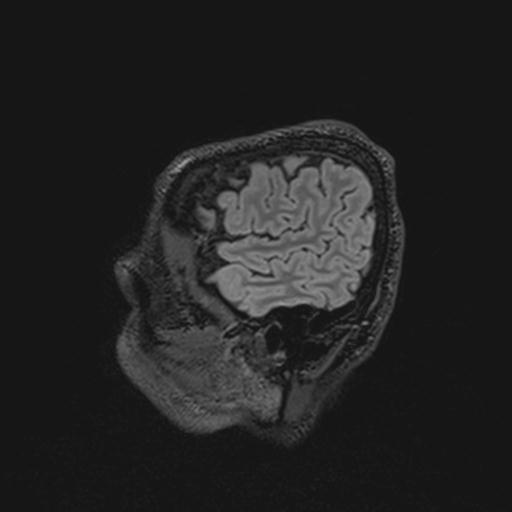 Autoimmune limbic encephalitis (Radiopaedia 30363-31005 Sagittal FLAIR 27).jpg
