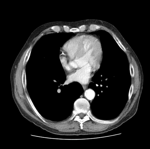 Autosomal dominant polycystic kidney disease (Radiopaedia 27851-28094 B 37).jpg