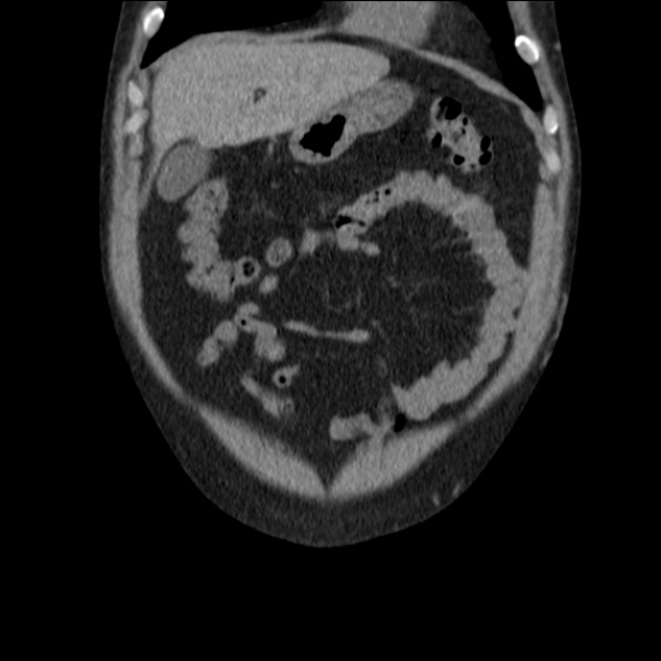 Autosomal dominant polycystic kidney disease (Radiopaedia 36539-38101 C 15).jpg