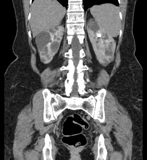 Autosomal dominant polycystic kidney disease (Radiopaedia 38189-40194 Coronal C+ delayed 78).jpg