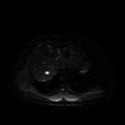 Autosomal dominant polycystic kidney disease (Radiopaedia 50259-55611 Axial DWI 4).jpg