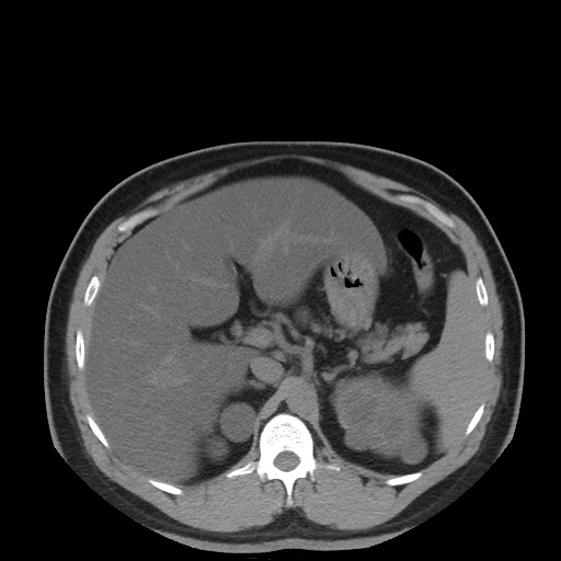 Autosomal dominant polycystic kidney disease (Radiopaedia 50259-55612 Axial non-contrast 27).jpg