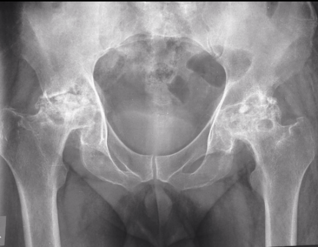 File:Avascular necrosis - bilateral hip joints (Radiopaedia 27239).PNG