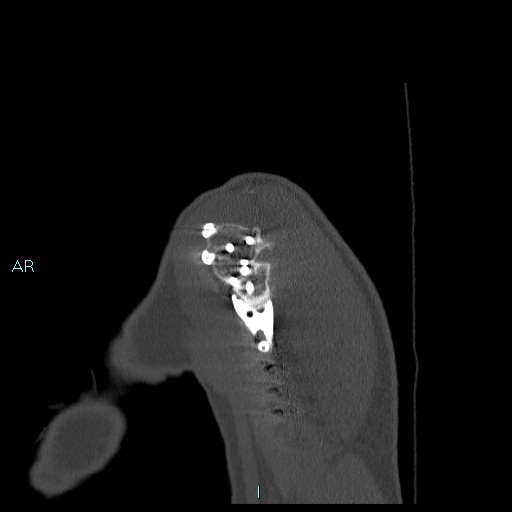 Avascular necrosis after fracture dislocations of the proximal humerus (Radiopaedia 88078-104655 Sagittal bone window 11).jpg