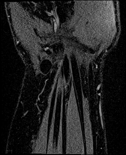 Avascular necrosis of the capitate (Radiopaedia 88317-104948 Coronal T1 vibe 76).jpg