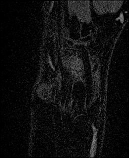 Avascular necrosis of the capitate (Radiopaedia 88317-104948 Coronal T1 vibe 9).jpg