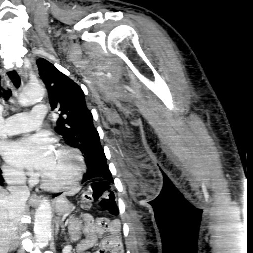 File:Axillary arterial pseudoaneurysm (Radiopaedia 24925-25195 B 4).jpg